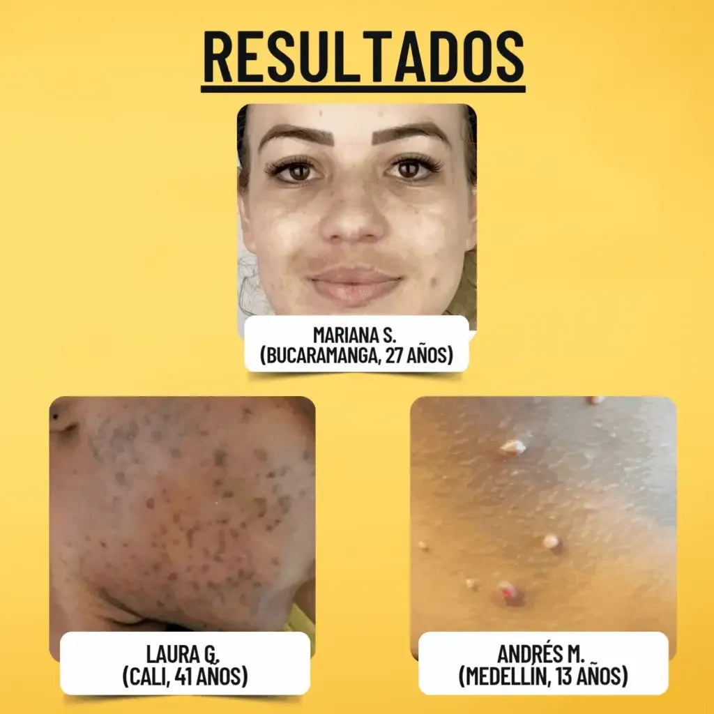 Tag Recede Eliminador de verrugas⭐⭐⭐⭐⭐,,(ENVIO GRATIS 🔥)PAGO CONTRA ENTREGA🚛